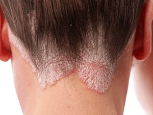 건선
psoriasis