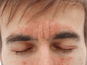 지루성 피부염
seborrheic dermatitis
