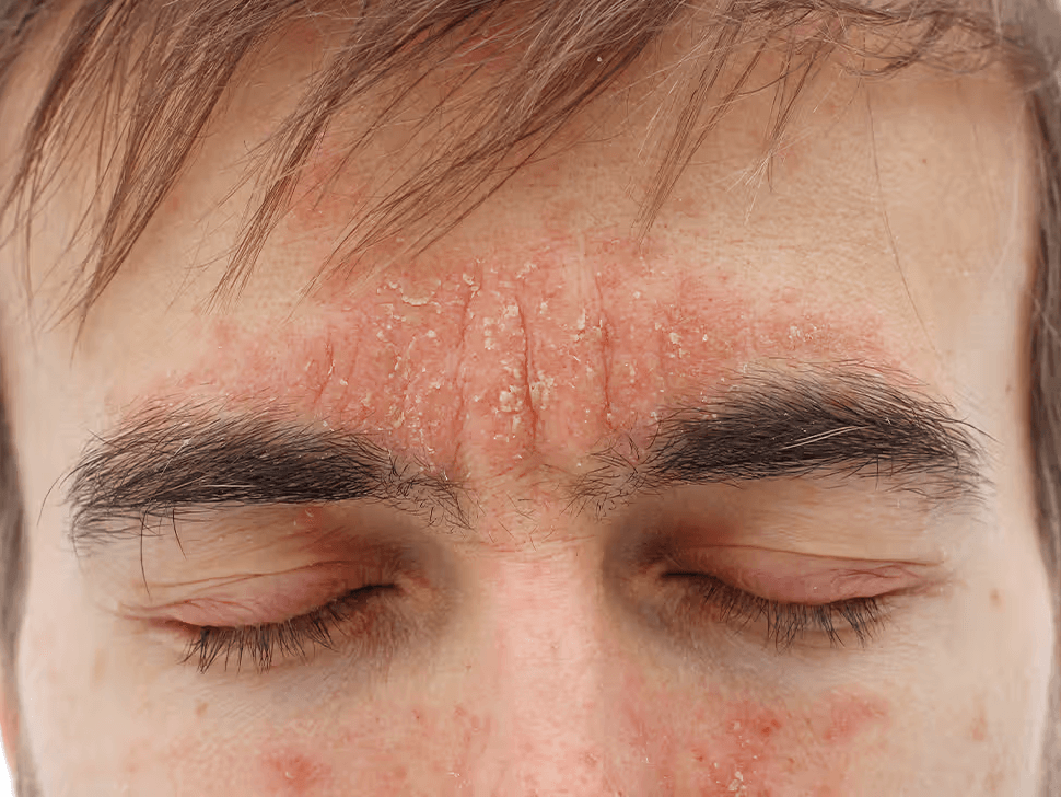 지루성 피부염 (seborrheic dermatitis)