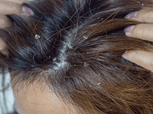 지루성 피부염
seborrheic dermatitis