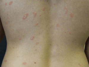 장미색 비강진
pityriasis rosea