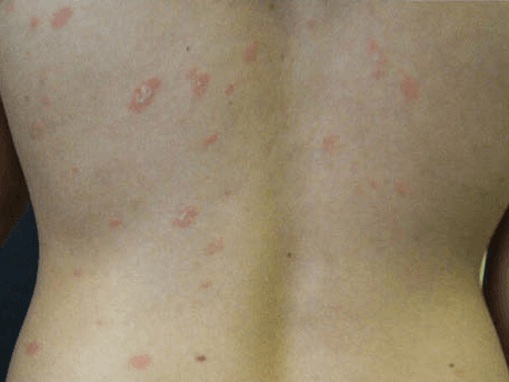 장미색 비강진 (pityriasis rosea)
