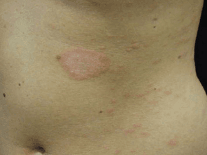 장미색 비강진
pityriasis rosea