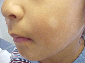 백색 비강진
pityriasis alba