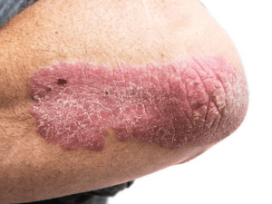 건선
psoriasis