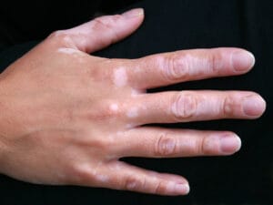 백반증
vitiligo
