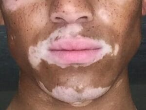 백반증
vitiligo