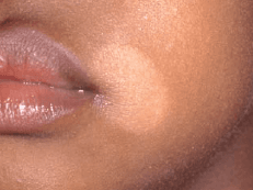 백색 비강진
pityriasis alba