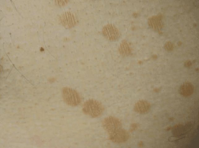 어루러기 (pityriasis versicolor)