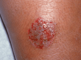 동전모양 습진
화폐상 습진
nummular eczema