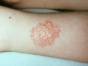 동전모양 습진
화폐상 습진
nummular eczema