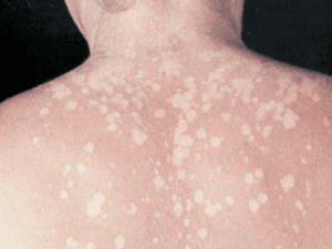 어루러기
pityriasis versicolor