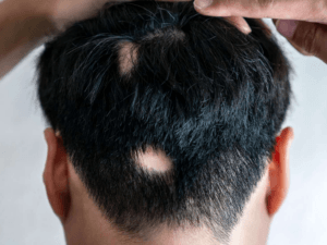 원형 탈모 (alopecia areata)