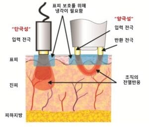 고주파 원리